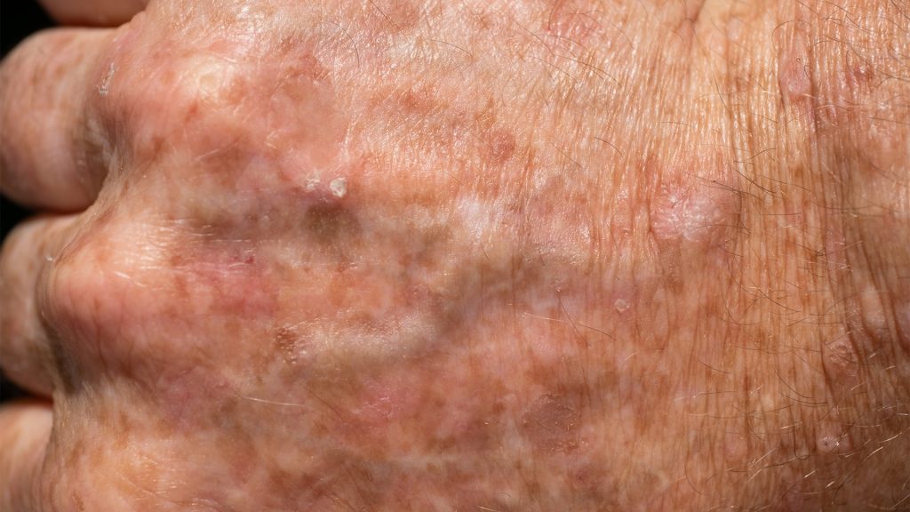 Actinic keratosis