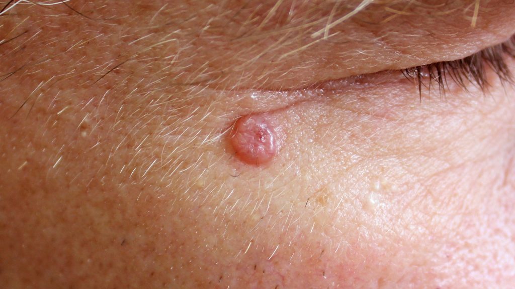 Basal Cell Carcinoma