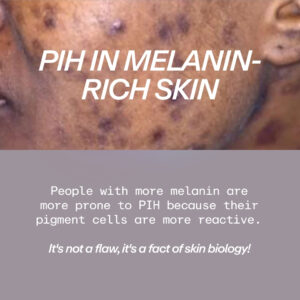 post-inflammatory hyperpigmentation