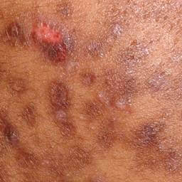 Hyperpigmentation