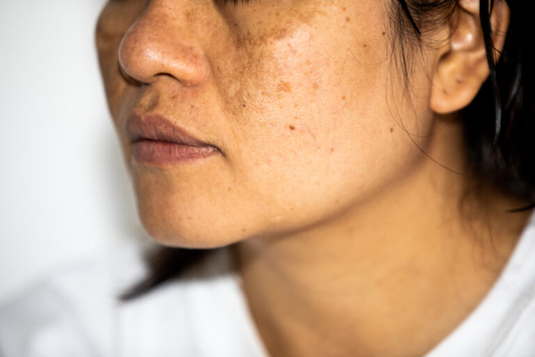Face with dark spots