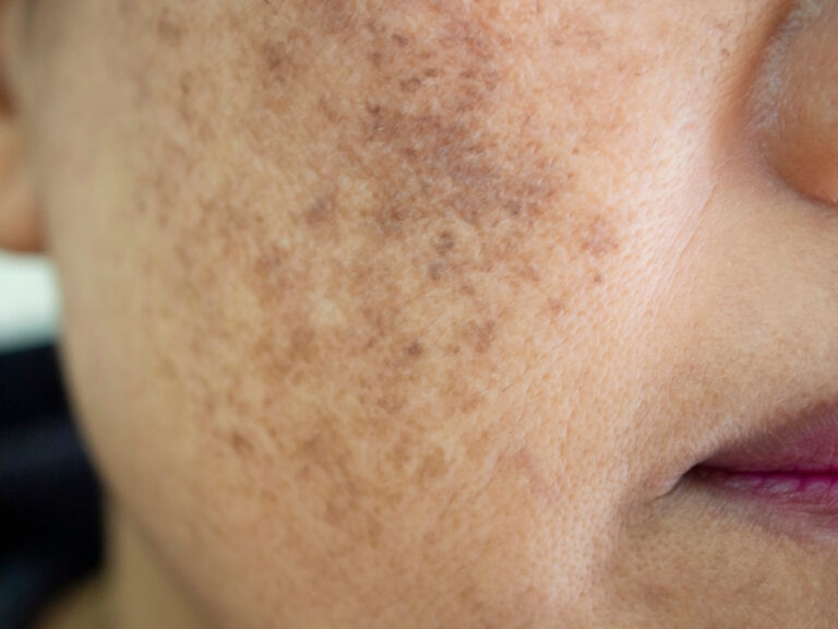 Melasma