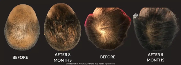 before after 8 monnths before after 5 months