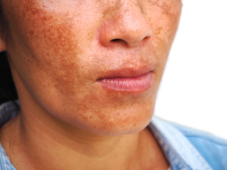 close,up,melasma,on,woman,face,,skin,problem