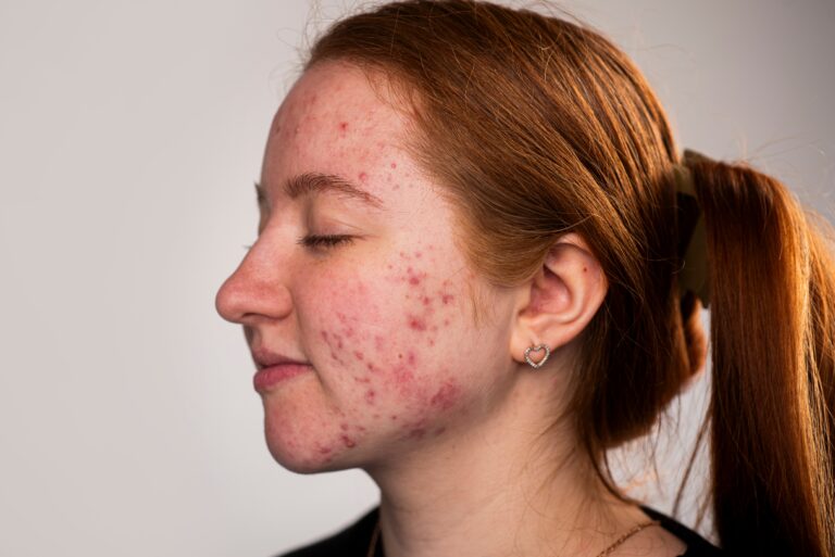 many,pimples.,girl,with,bad,skin.,hormonal,acne,,puberty.,skin