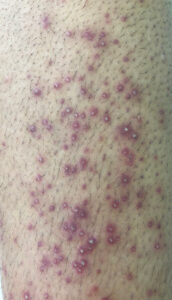 Bacterial Folliculitis
