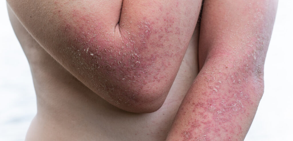 dyshidrotic,autoimmune,eczema,of,patient.,concept,of,health,care