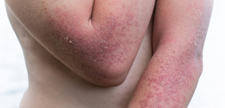 dyshidrotic,autoimmune,eczema,of,patient.,concept,of,health,care