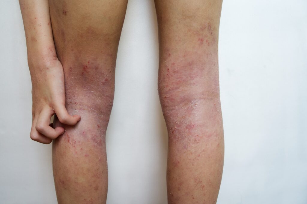 allergy,skin,of,an,asian,kid,on,her,legs,with