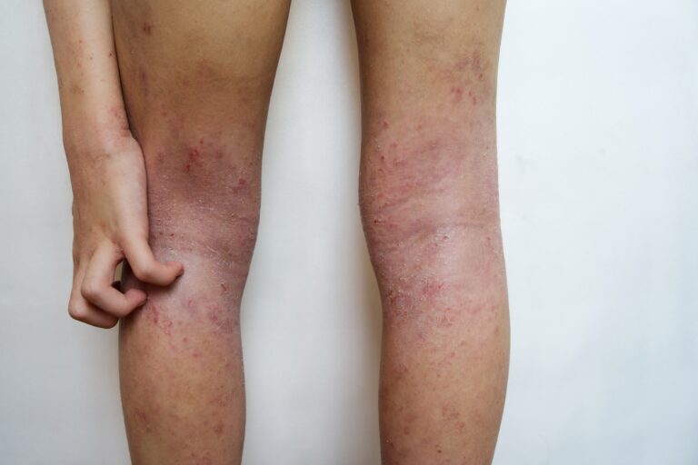 allergy,skin,of,an,asian,kid,on,her,legs,with