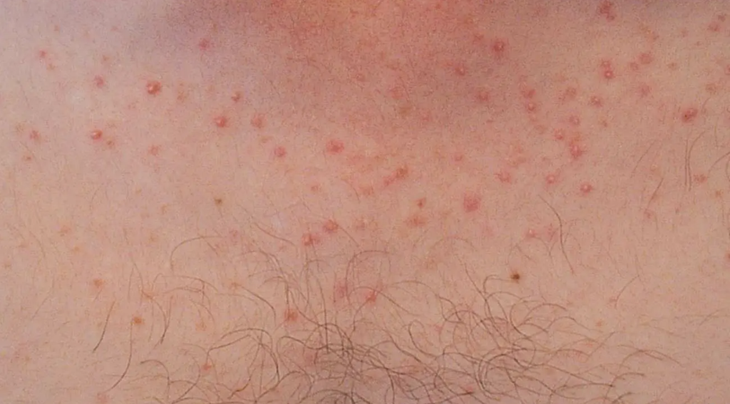 Small, pinpoint erythematous papules and pustules centered on hair follicles with a uniform appearance and lack of comedones. Distribution and morphology are characteristic of Pityrosporum (Malassezia) folliculitis, a fungal cause often mistaken for acne.