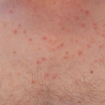 Small, pinpoint erythematous papules and pustules centered on hair follicles with a uniform appearance and lack of comedones. Distribution and morphology are characteristic of Pityrosporum (Malassezia) folliculitis, a fungal cause often mistaken for acne.