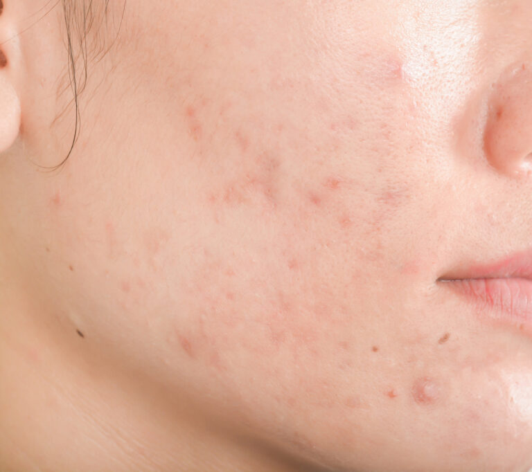 Close-up of inflammatory acne lesions on the jawline illustrating hormonal patterns; Medical dermatology bottle showing active acne-fighting ingredients alongside a skin health guide.