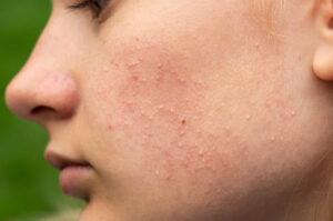 Comedonal Acne