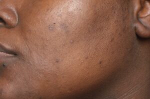 Postinflammatory Hyperpigmentation due to acne