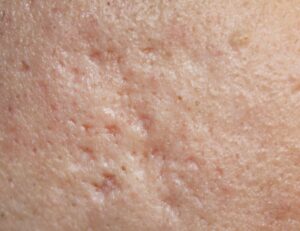 Permanent Acne Scarring