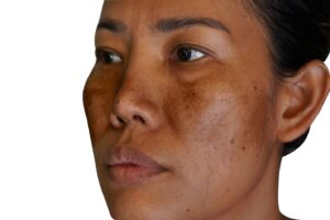 melasma image (12)