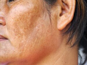 melasma image (5)
