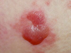 trauma or heat blisters image (1)