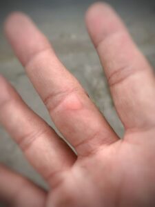 trauma or heat blisters image (10)