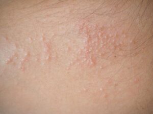 trauma or heat blisters image (2)
