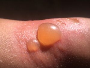 trauma or heat blisters image (4)
