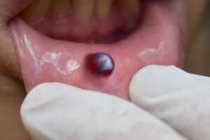trauma or heat blisters image (5)
