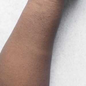 trauma or heat blisters image (8)