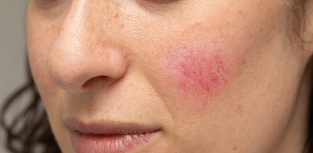 woman,with,blotchiness,on,the,cheek,caused,by,bacterial,infectio