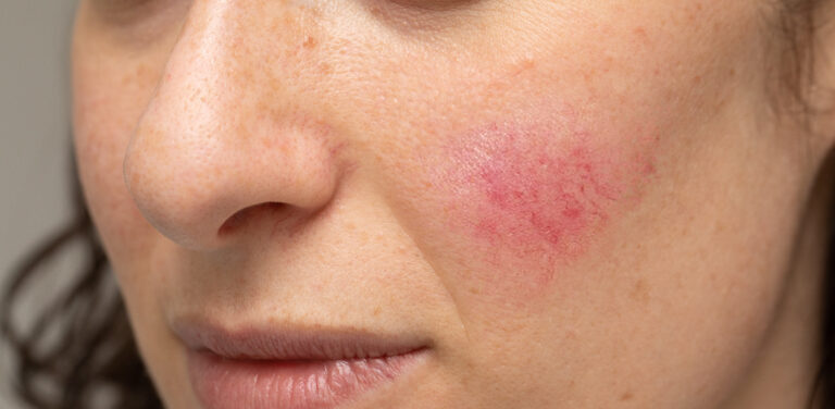 woman,with,blotchiness,on,the,cheek,caused,by,bacterial,infectio