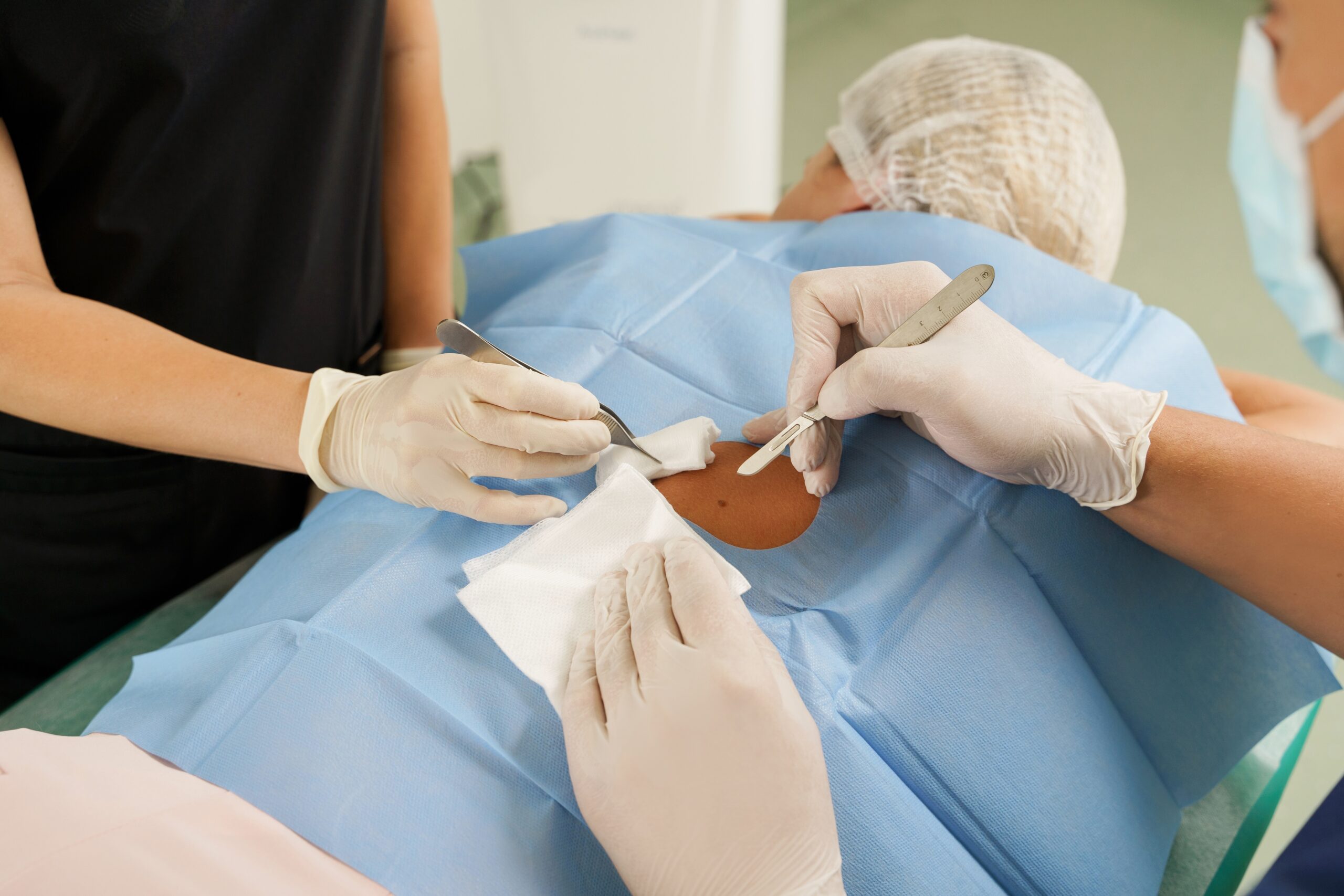 Diagram showing the step-by-step Mohs surgery process of removing and mapping tissue layers