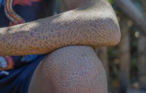 ichthyosis compressed