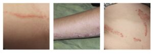 Inflammatory linear verrucous epidermal naevus ILVEN compressed