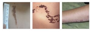 Linear Epidermal Nevus compressed
