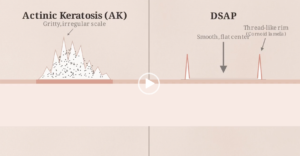 Actinic Keratosis Video
