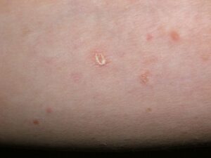 pityriasis lichenoides 0005 compressed