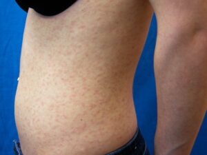 pityriasis lichenoides 0010 compressed