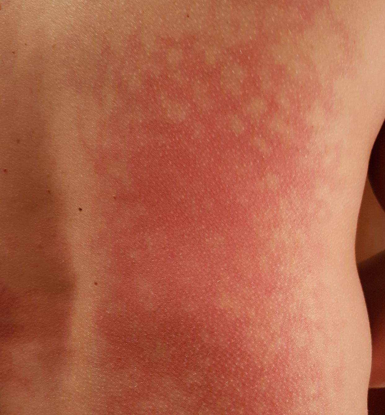 Understanding Your Skin: A Guide to Erythema Ab Igne (Heat-Induced Rash ...