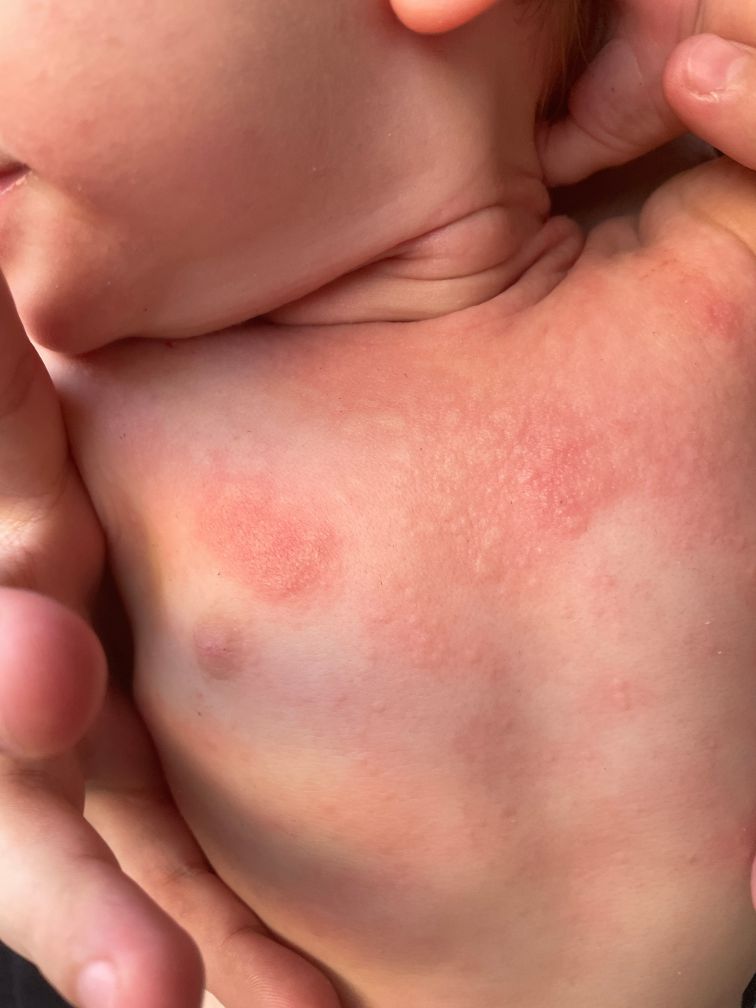 Taking Charge of Your Health: A Patient’s Guide to Atopic Dermatitis ...