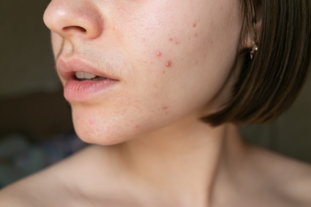 Inflammatory acne breakout on lower cheek and jawline area with visible facial hair growth indicating hormonal skin triggers.