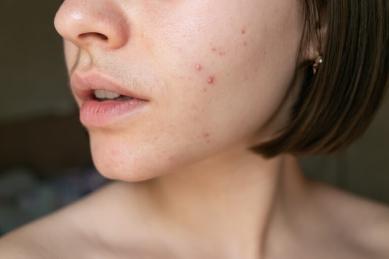 Inflammatory acne breakout on lower cheek and jawline area with visible facial hair growth indicating hormonal skin triggers.