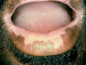 vitiligo on the lips of a male