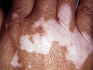 vitiligo 0034 compressed