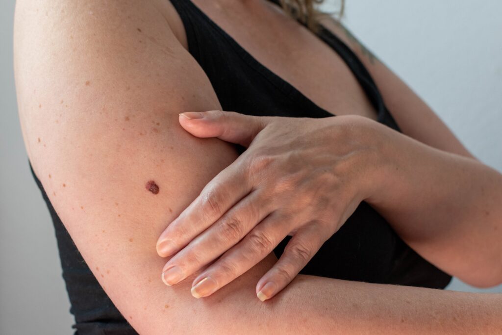 a,large,and,unusual,mole,or,freckle,on,a,woman's