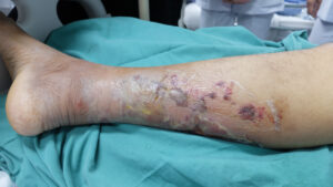 cellulitis,and,blisters,at,right,leg,in,diabetic,patient