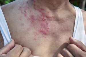 raised,red,bumps,,skin,rash,and,blisters,on,body,caused