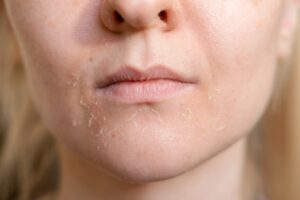 the,woman,skin,flakes,off,at,the,mouth.,dry,skin