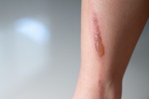 woman,leg,blistered,and,red,skin,from,accidental,scalds