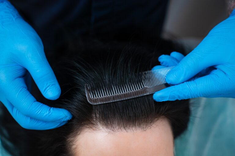 Traction alopecia causing thinning along the frontal hairline