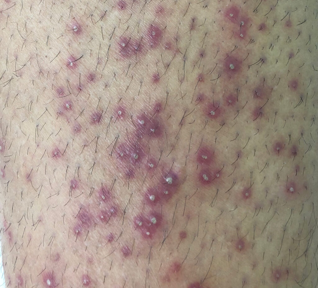 Close-up of fungal folliculitis causing clusters of small red bumps and pustules around hair follicles